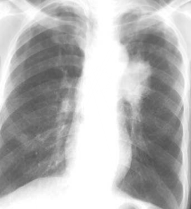 左侧型肺癌.png