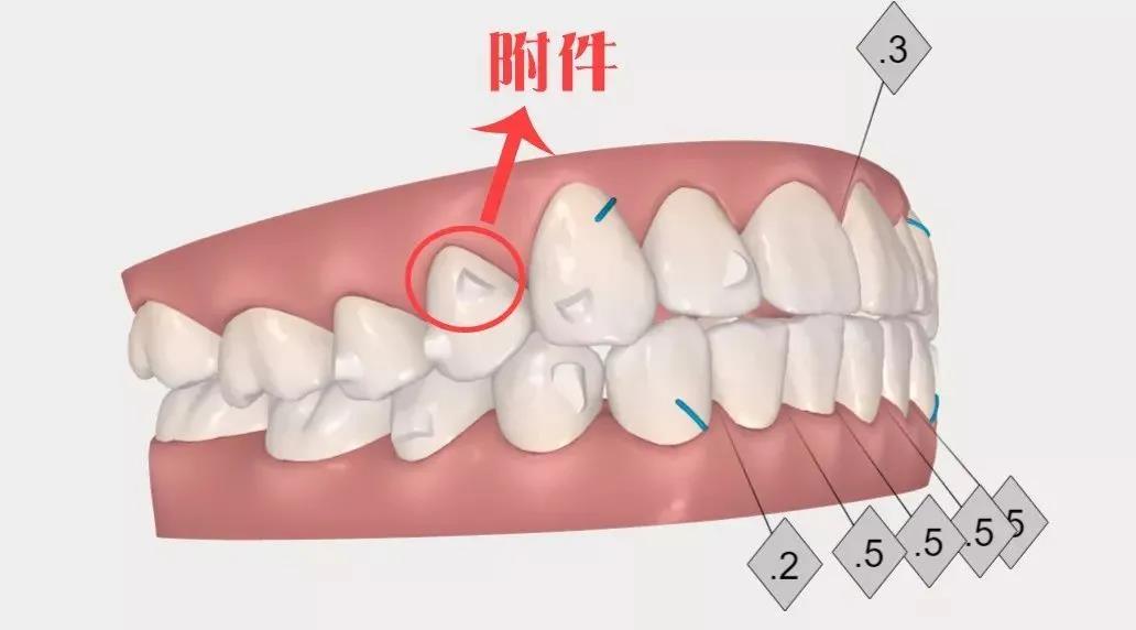 关于隐形牙套的附件你想知道的都在这儿