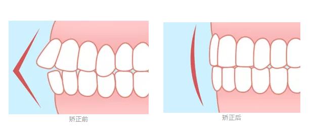 做矫正牙齿内收量与哪些因素相关